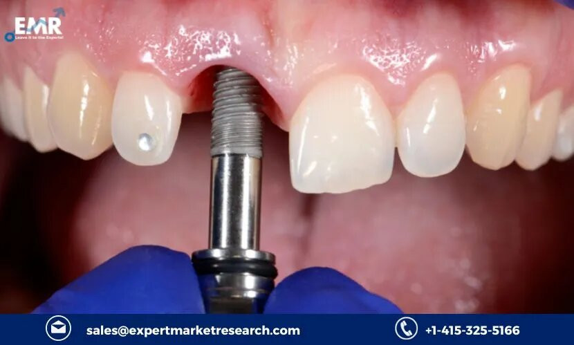 Aesthetic Implants Market Booming:  A 7.8% CAGR Projected to 2032 - What's Driving This Trend?