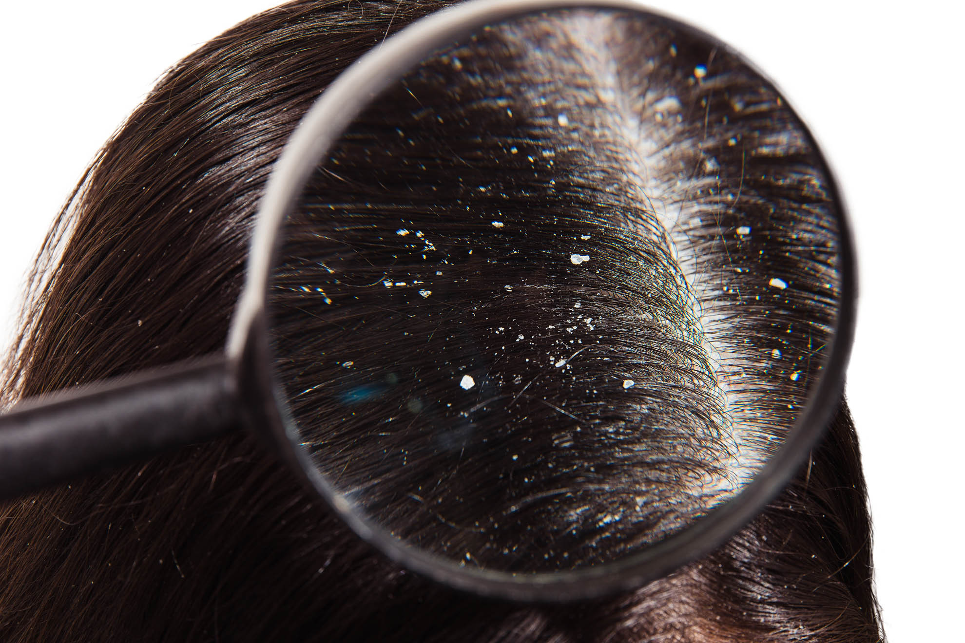 Dandruff: The Ultimate Guide to Getting Rid of It For Good