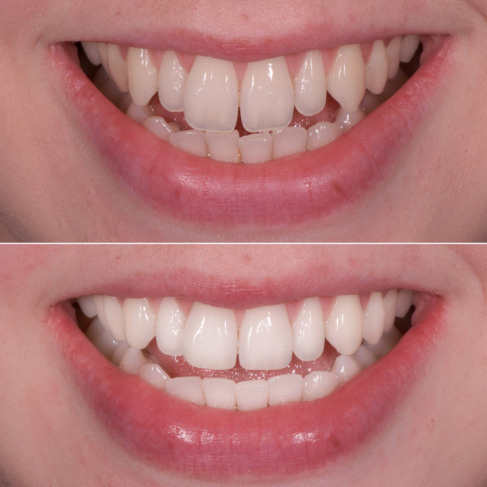 Dental Contouring: A Smile Makeover That's More Than Just Veneers