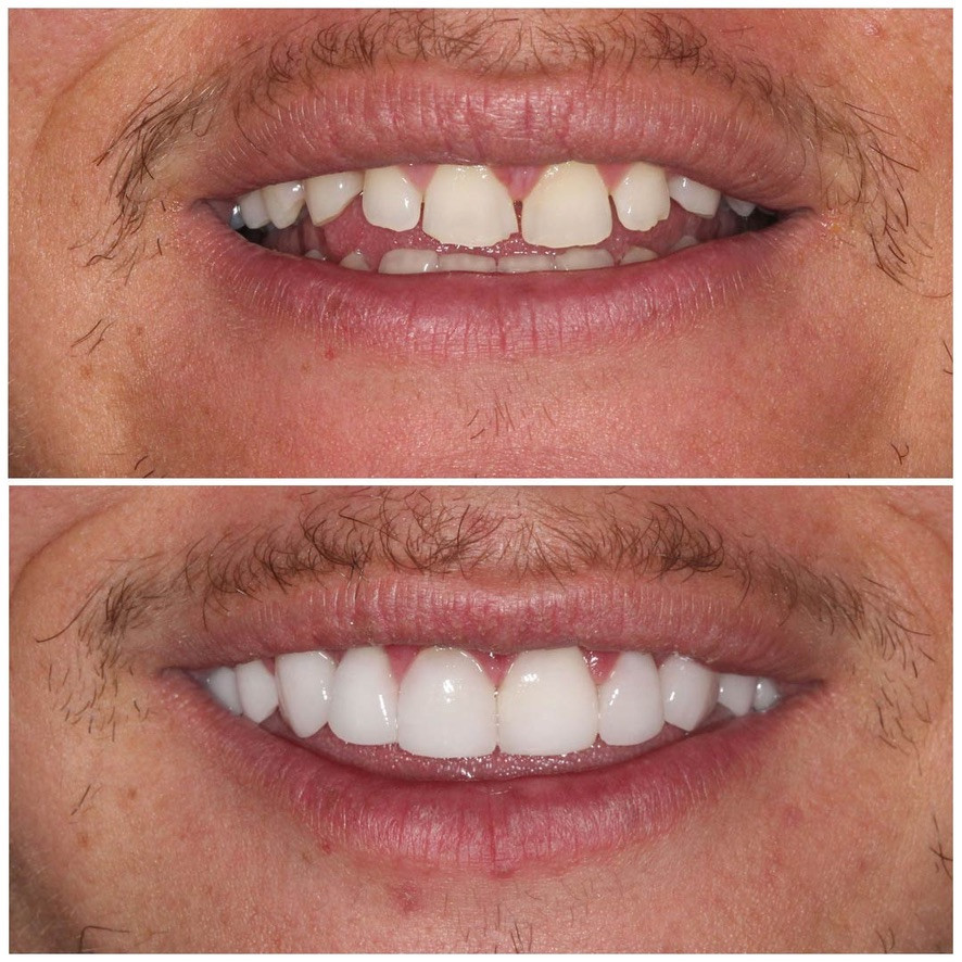 Dental Contouring: A Smile Makeover That's More Than Just Veneers