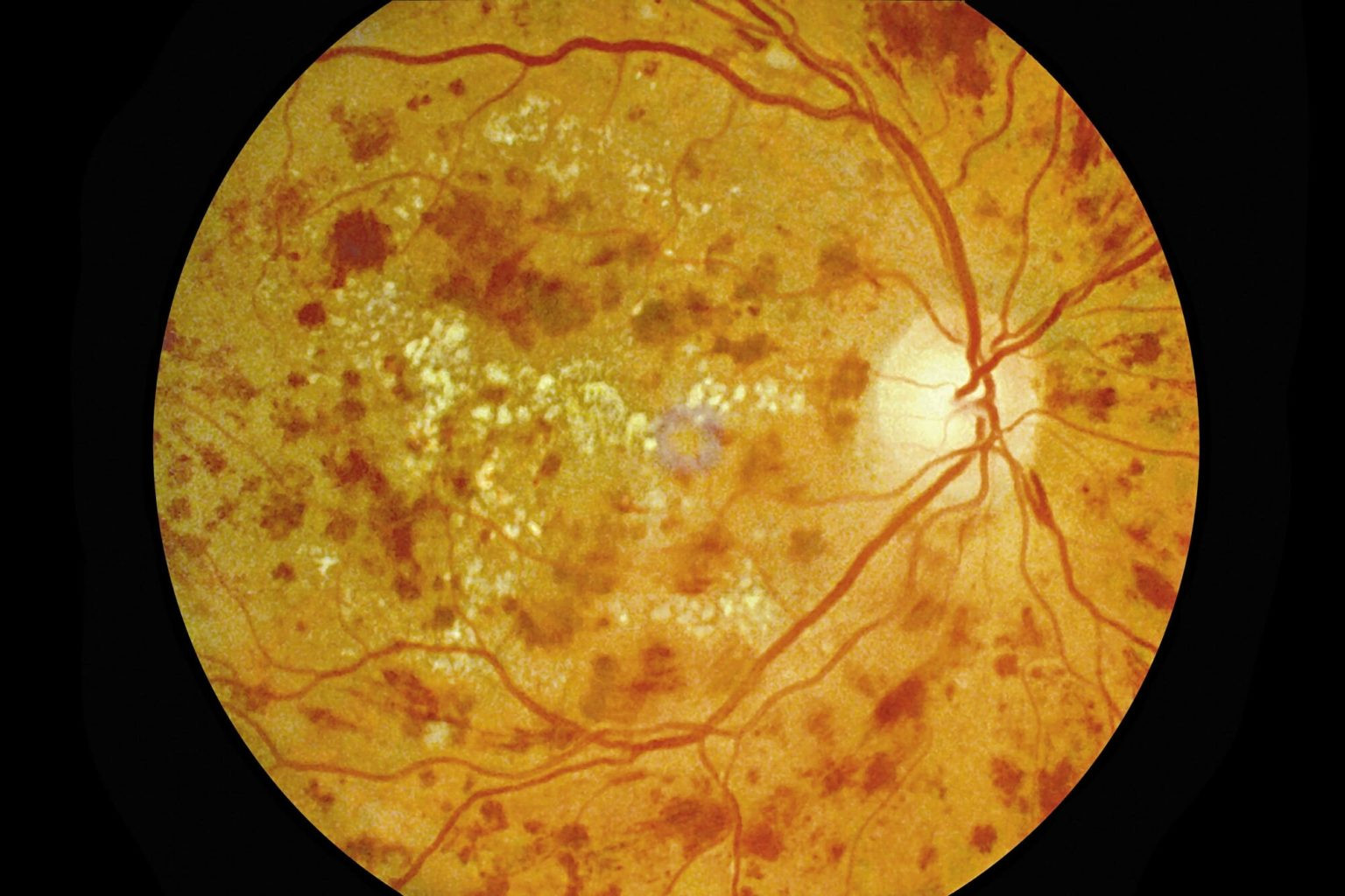 Diabetic Retinopathy: A Growing Global Threat to Vision