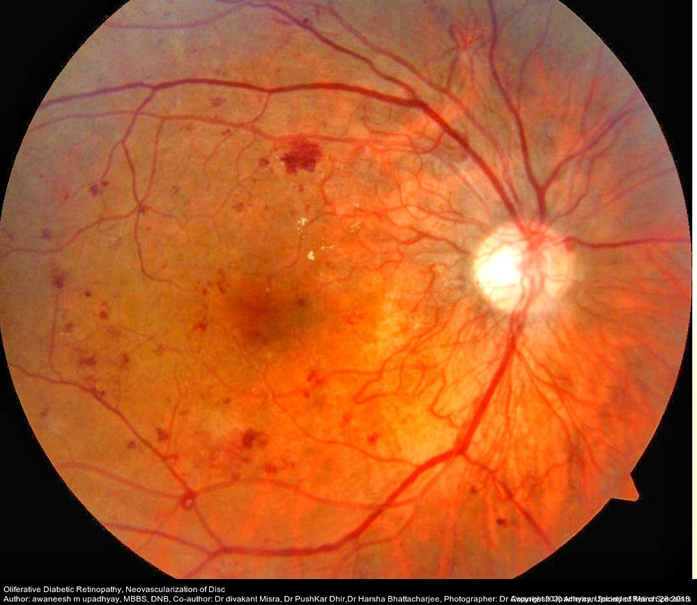 Diabetic Retinopathy: A Growing Global Threat to Vision