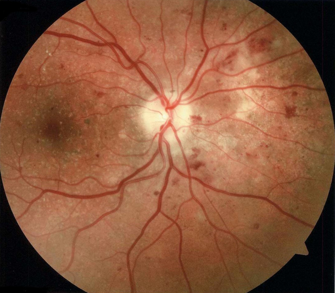 Diabetic Retinopathy: A Growing Global Threat to Vision