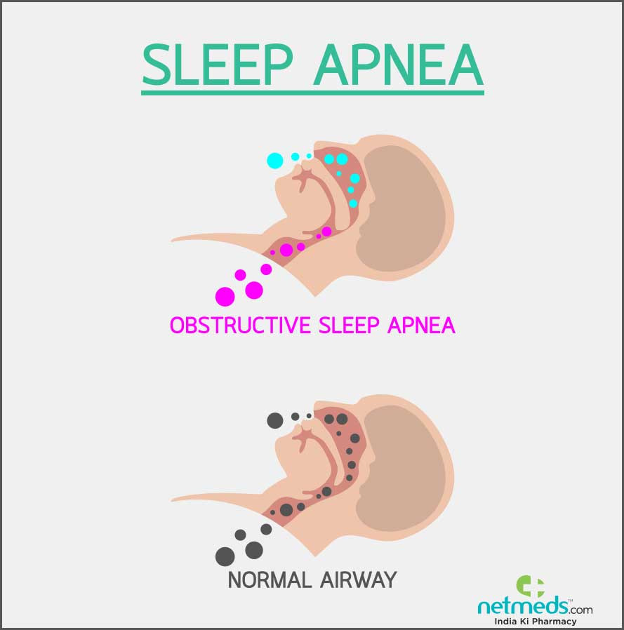 Epilepsy Drug Shows Promise in Treating Sleep Apnea: Could This Be the Answer for Snoring Sufferers?