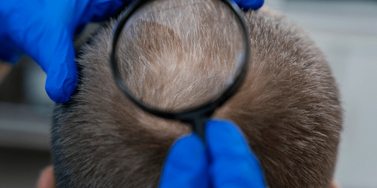 Hair Transplants: Why Turkey is No Longer the Only Destination for Women Seeking Hair Restoration