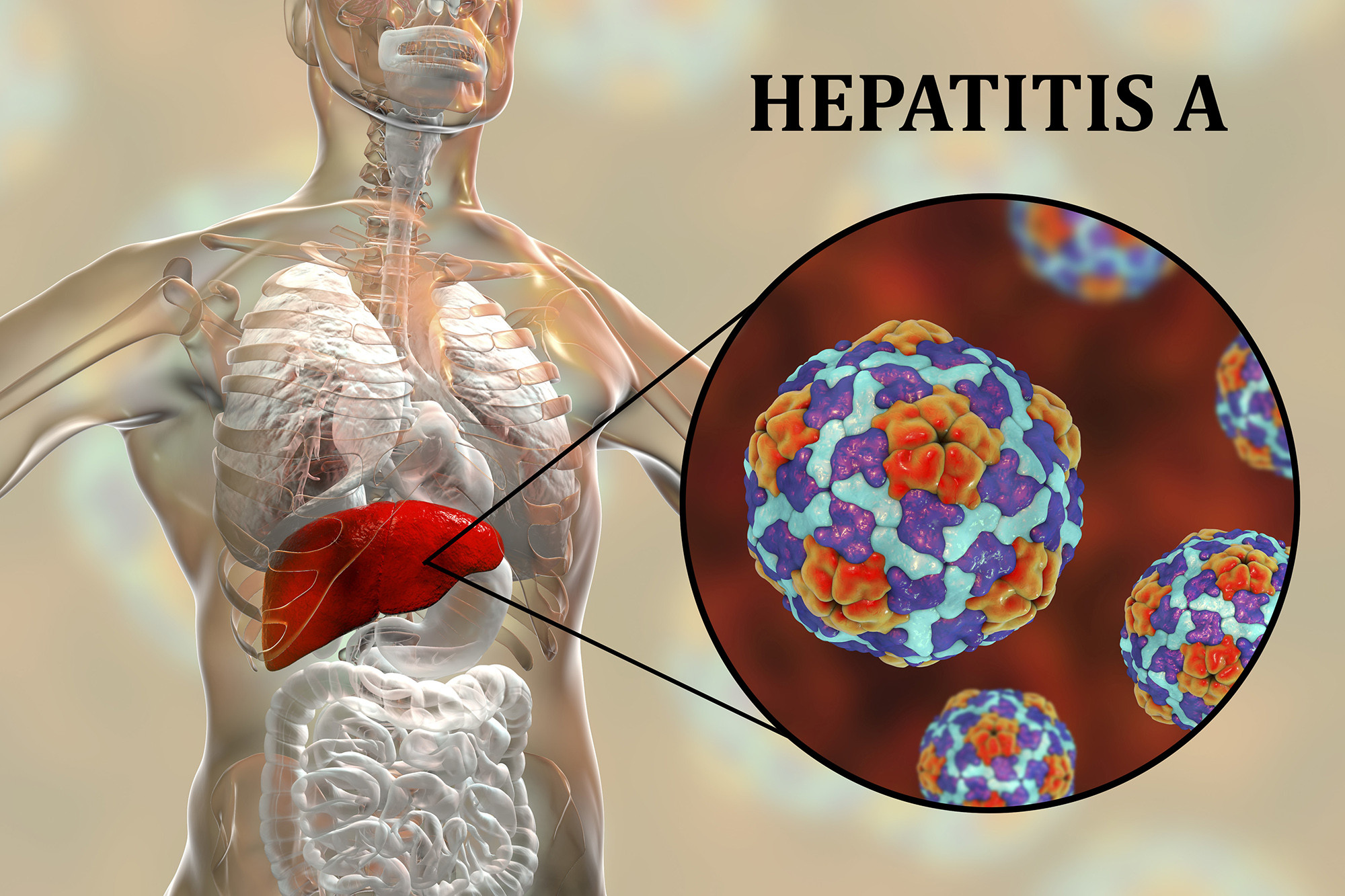 Hepatitis A Outbreak in Cumbernauld: What You Need to Know