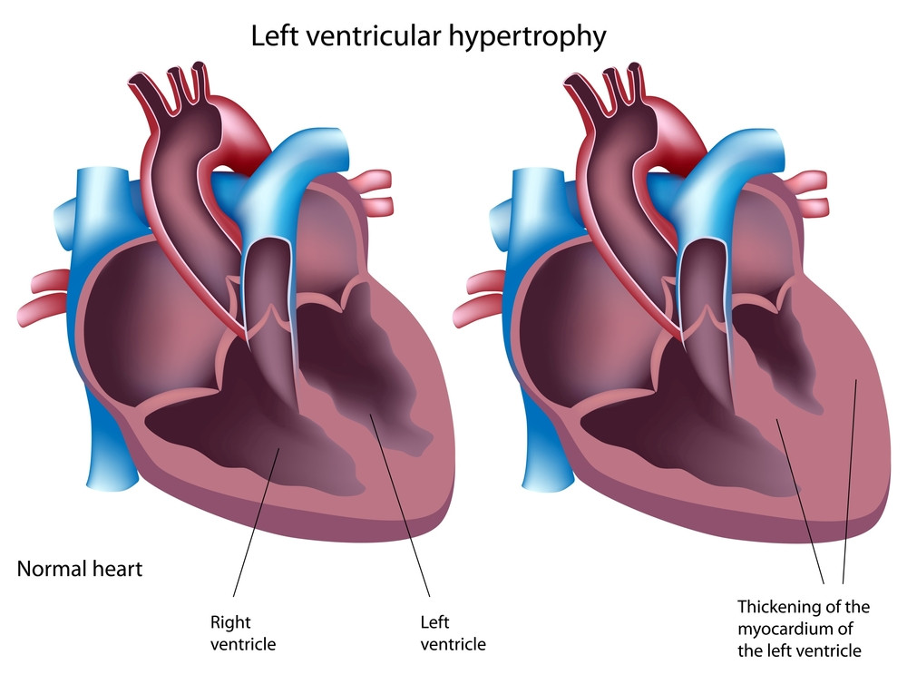 Hypertrophic Cardiomyopathy Therapeutics Market: A Booming Industry with a Promising Future