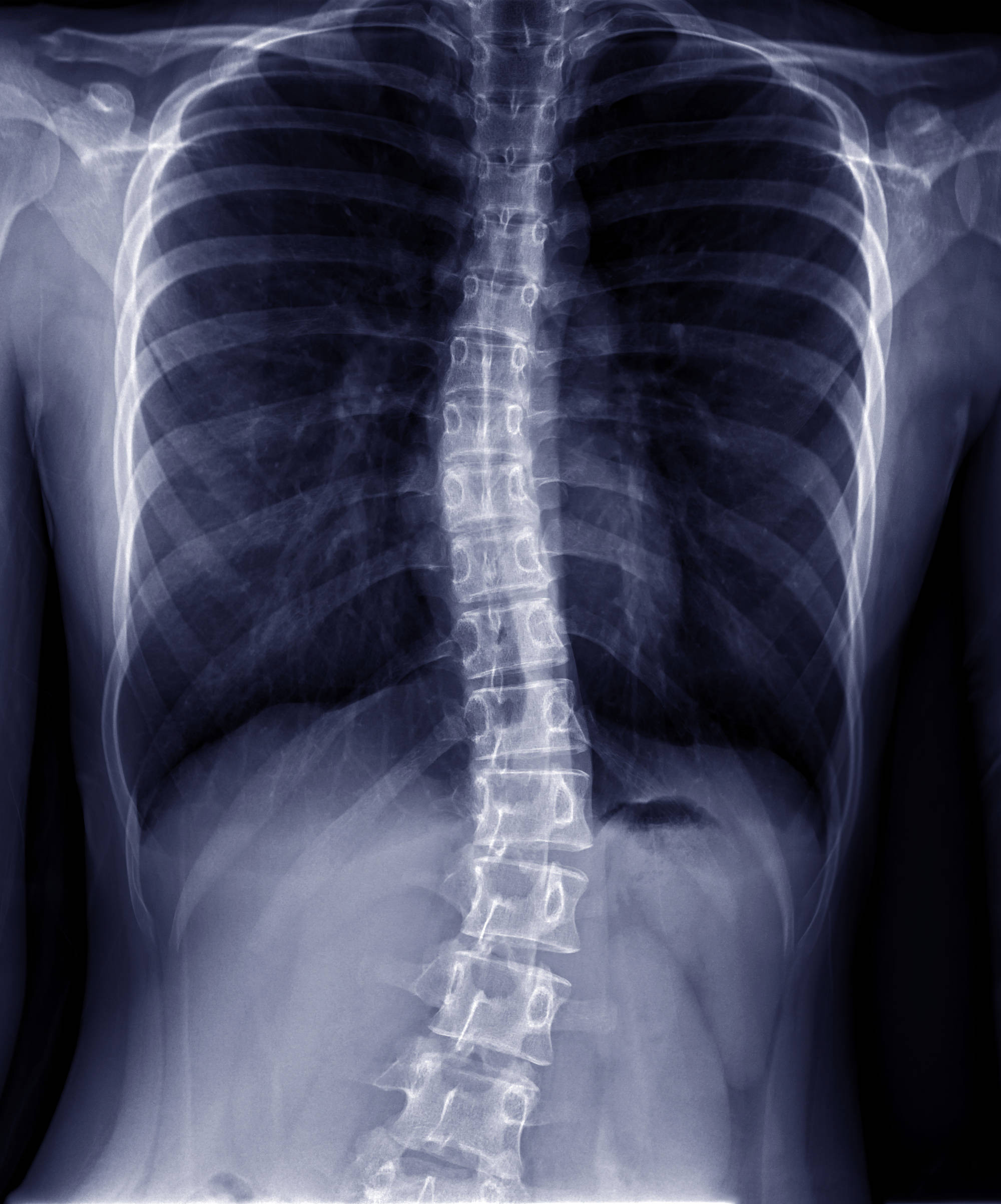 Irish Boy, 8, Removed From Urgent Scoliosis Surgery List Without Parents' Knowledge: 'I'm Scared He's Going To Die'