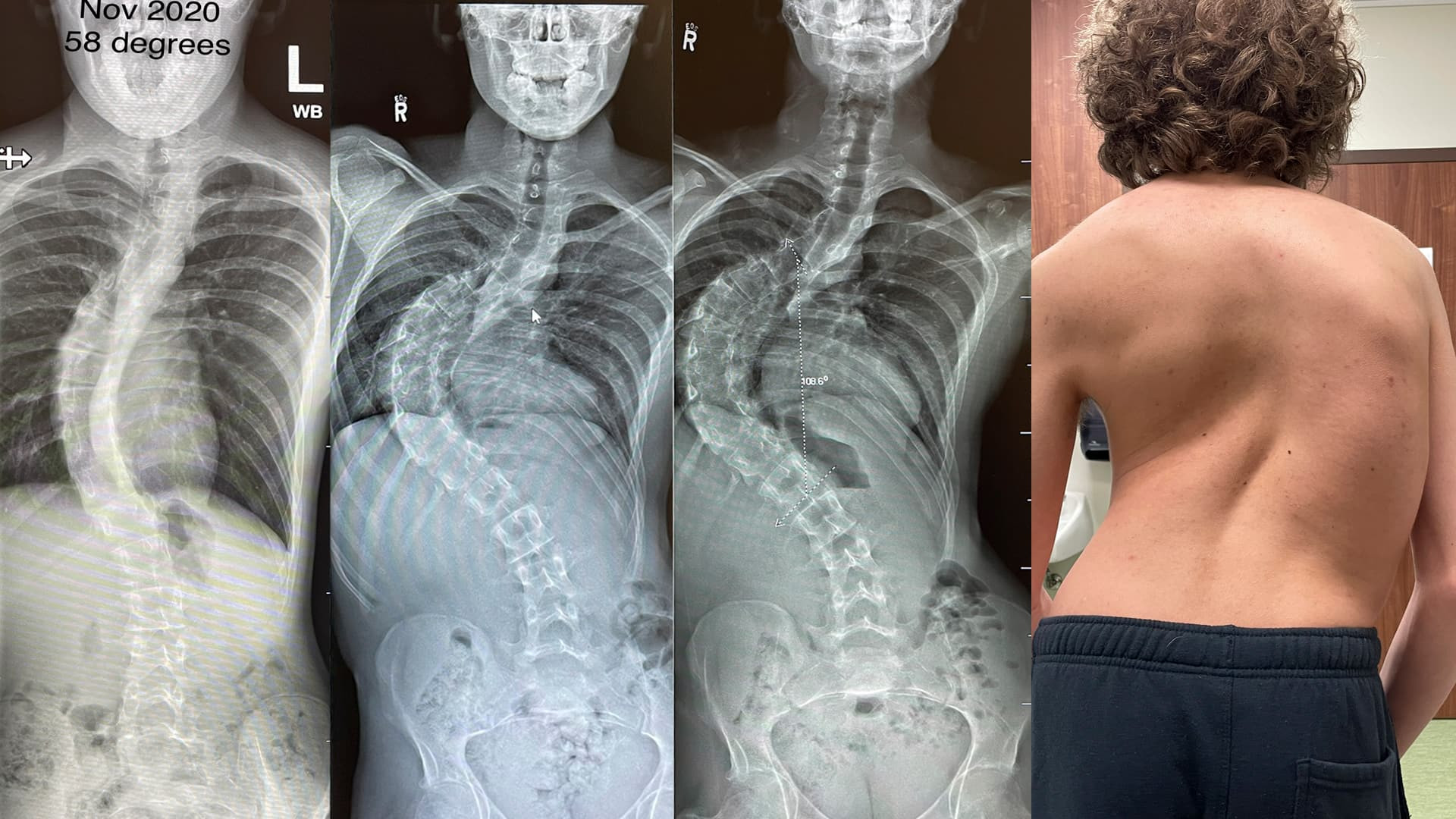 Irish Boy, 8, Removed From Urgent Scoliosis Surgery List Without Parents' Knowledge: 'I'm Scared He's Going To Die'