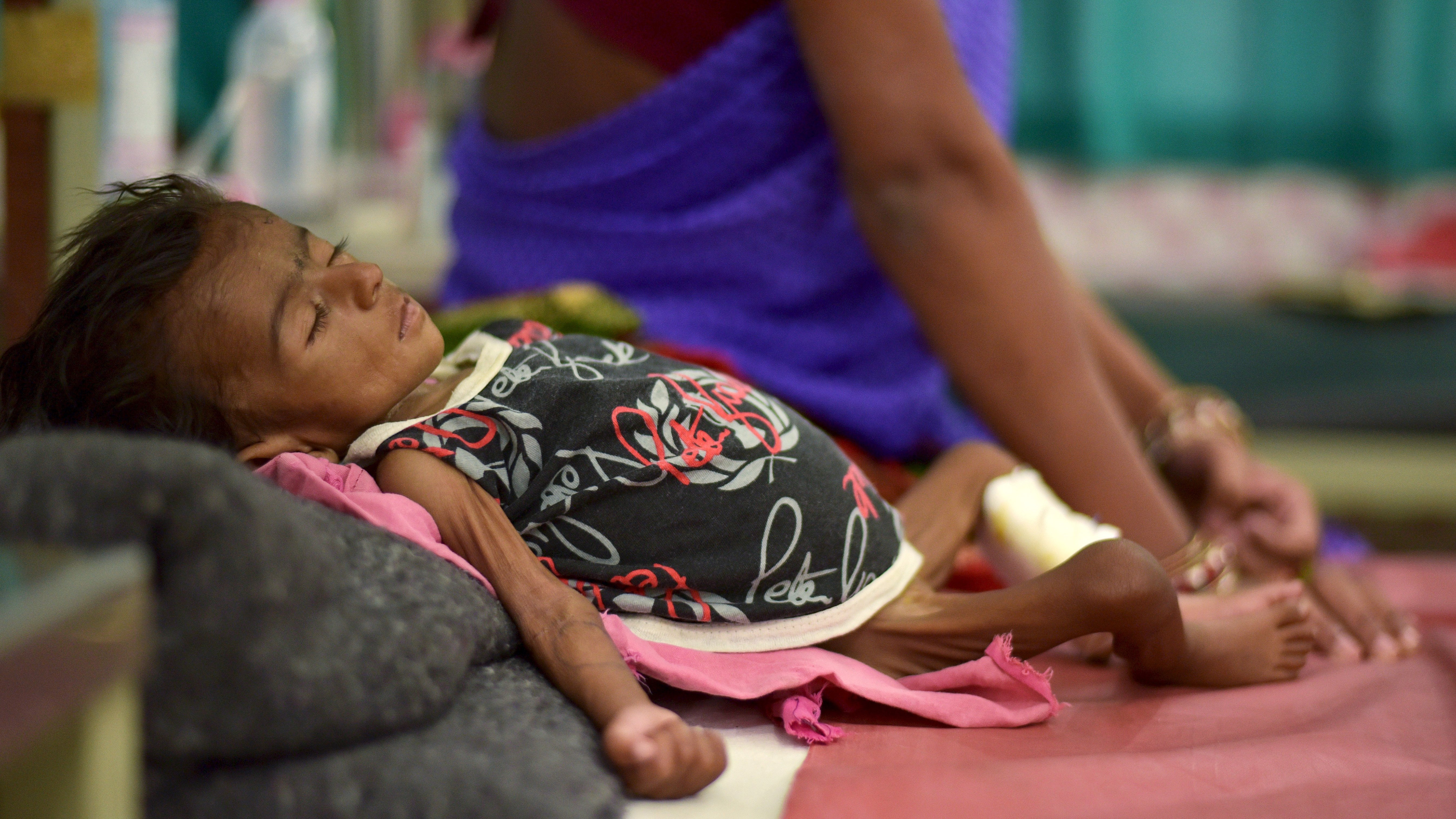 Is India Overestimating Child Malnutrition? The Surprising Truth About Stunting and Wasting