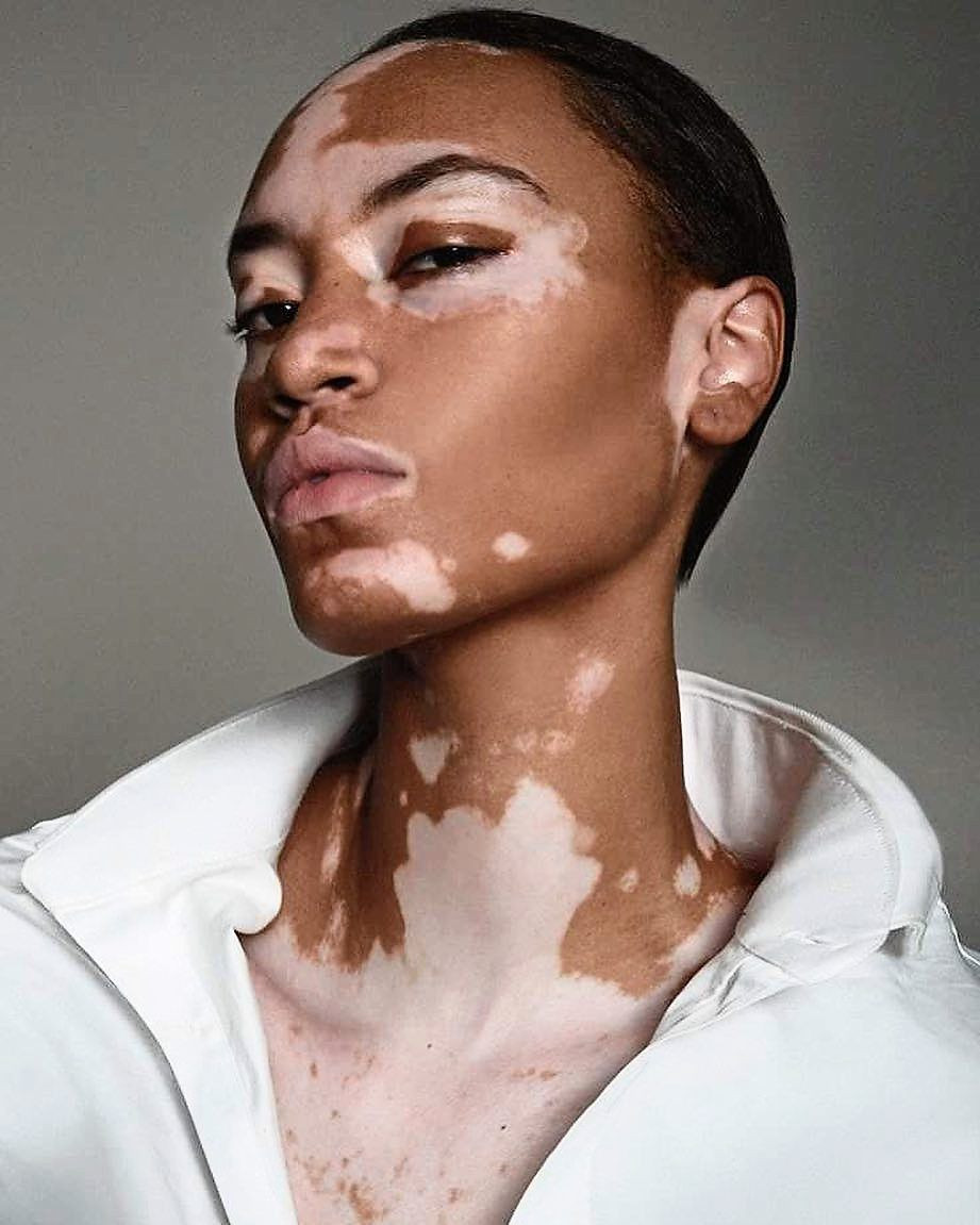 Living with Vitiligo: One Woman's Journey of Acceptance and Advocacy