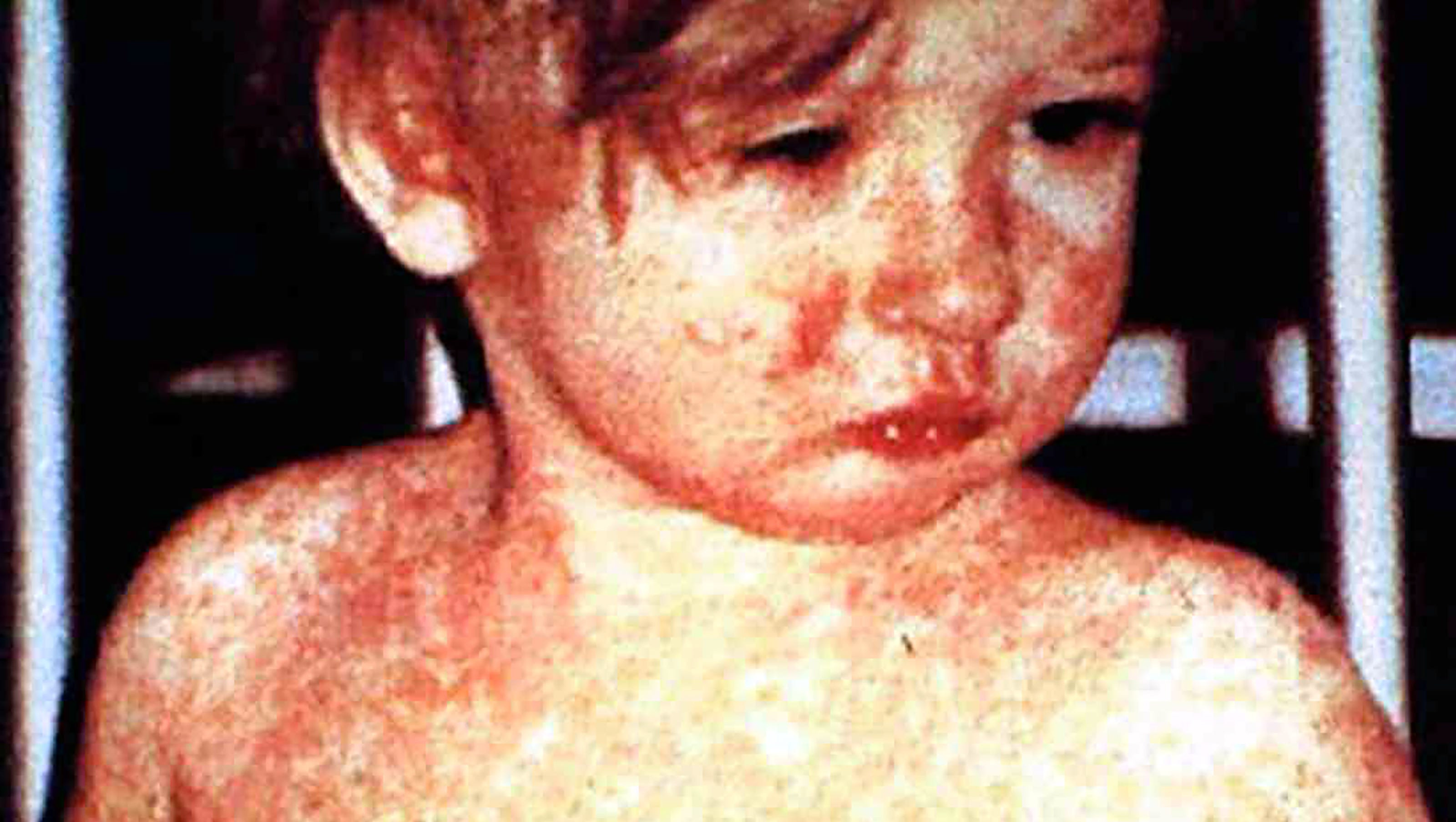 Measles Alert: Passengers on Dublin Airport Bus Urged to Watch for Symptoms