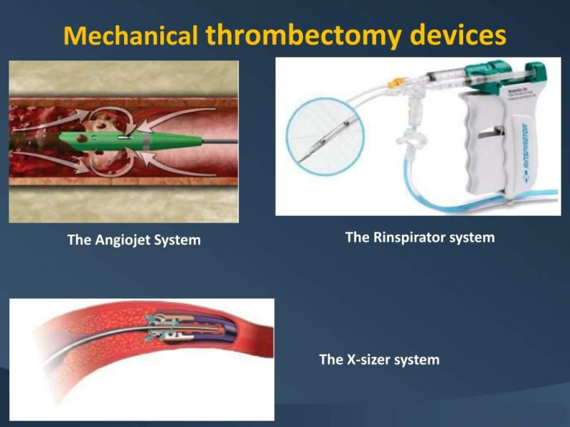 Mechanical Thrombectomy Devices Market to Reach USD XX Billion by 2031: InsightAce Analytic Report