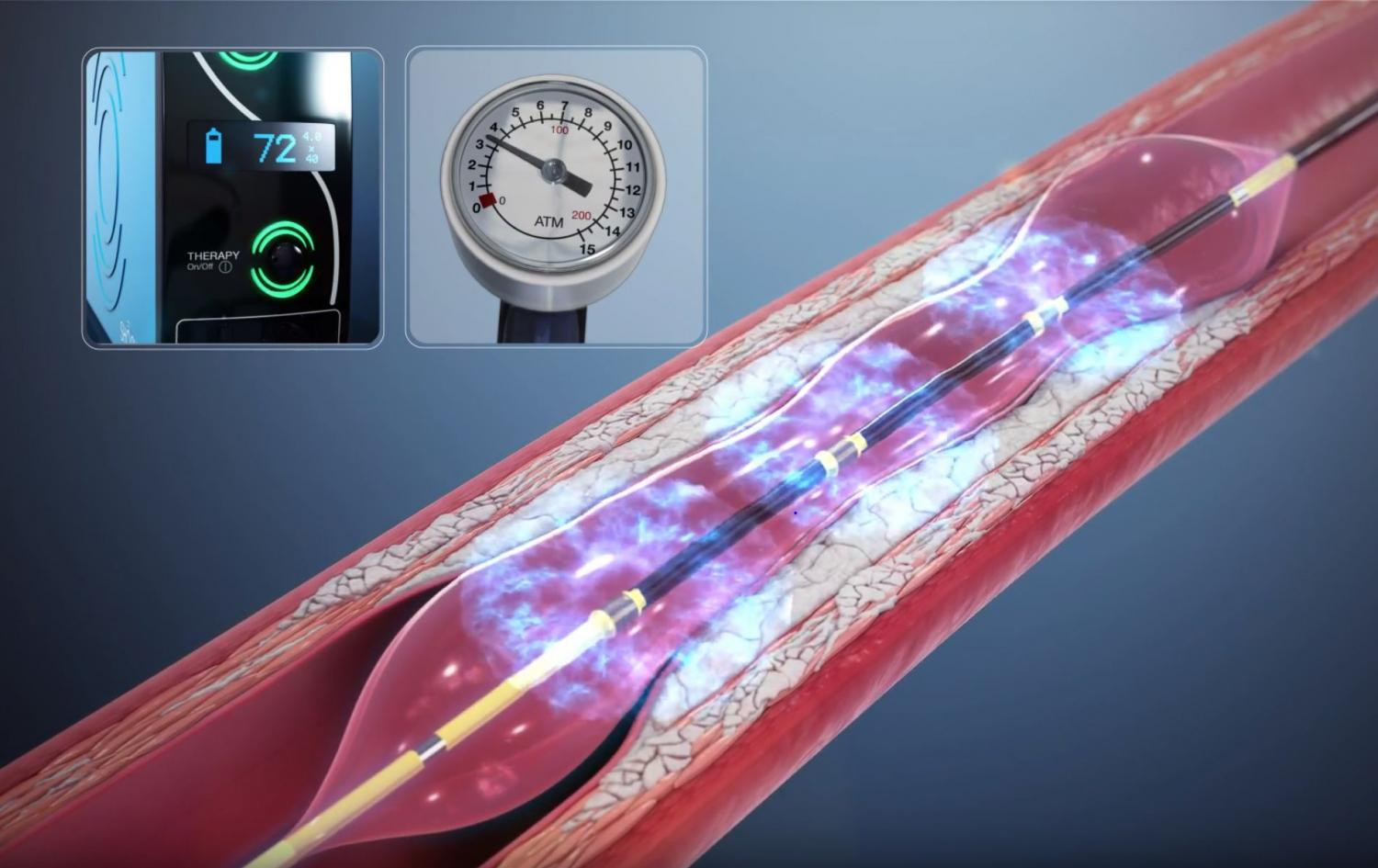 New IVL System Aims to Revolutionize Treatment for Coronary and Carotid Lesions