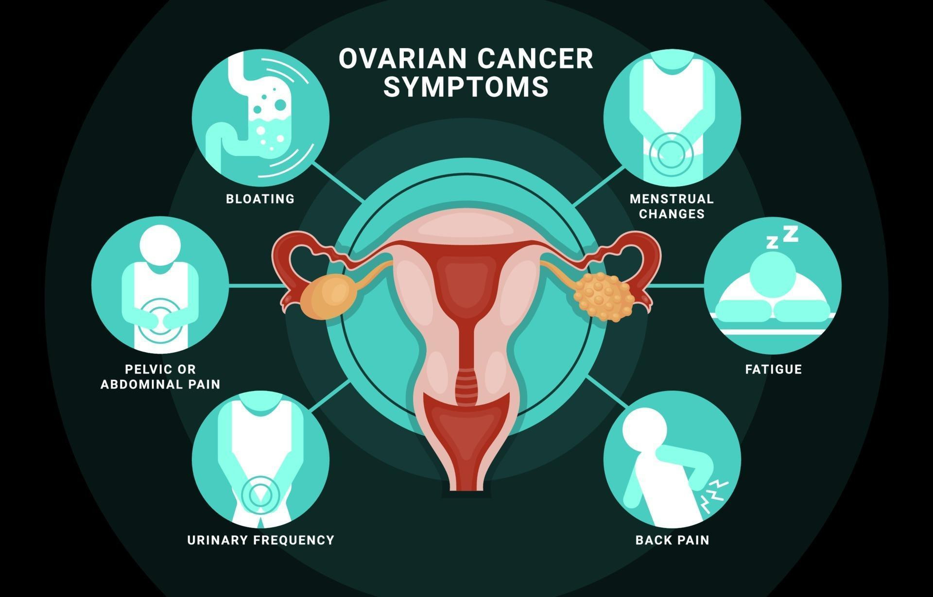 Ovarian Cancer: 4 Symptoms You Should Never Ignore