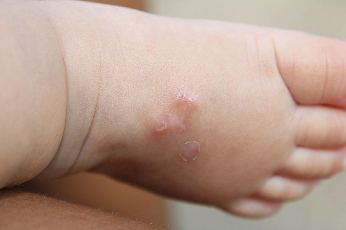 Scabies Outbreak Spreads Across Four NSW Hospitals: Health Officials Urge Residents to Monitor Symptoms