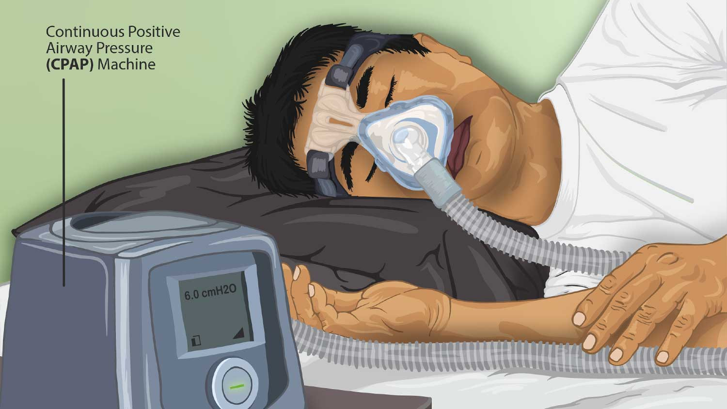 Sleep Apnea Patients Seek Pill-Based Treatment: Survey Reveals Dissatisfaction with CPAP