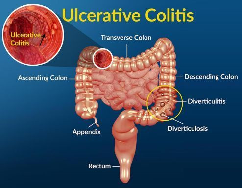 Ulcerative Colitis Treatment Market Booming: New Drugs and Therapies Drive Growth