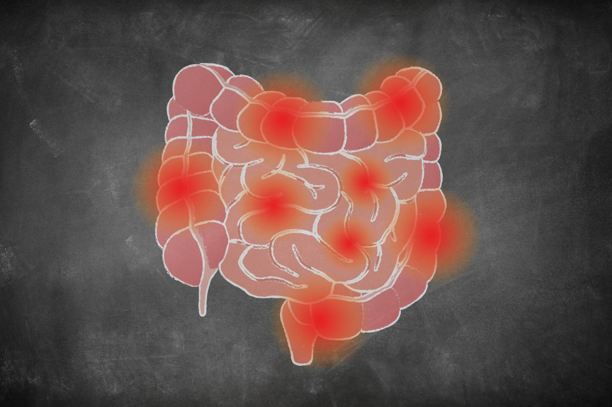 Urgent Toilet Trips & Blood in Stool? 8 Crucial Facts About Crohn's & Colitis You Need to Know