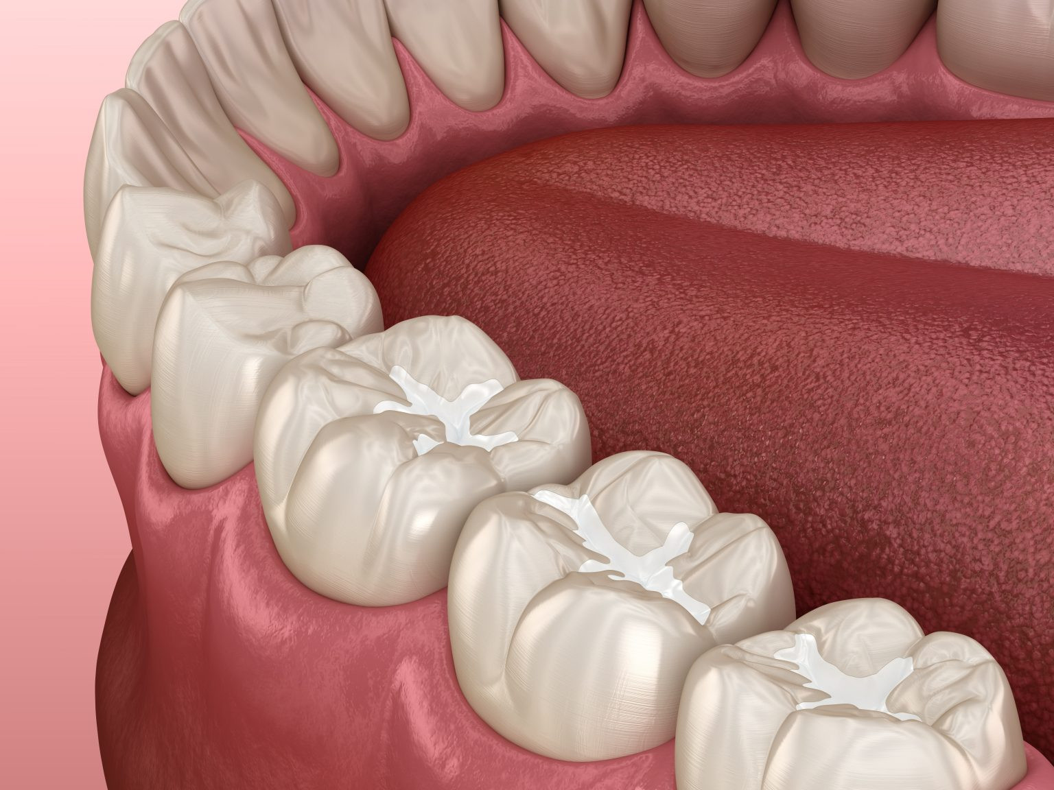 US Dental Filling Market Booming: Composite Resins Leading the Charge