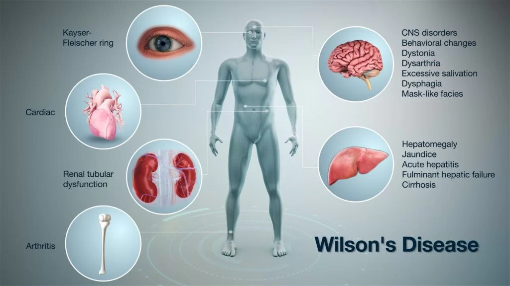 Wilson's Disease: When Neurological Symptoms Are the First Clue