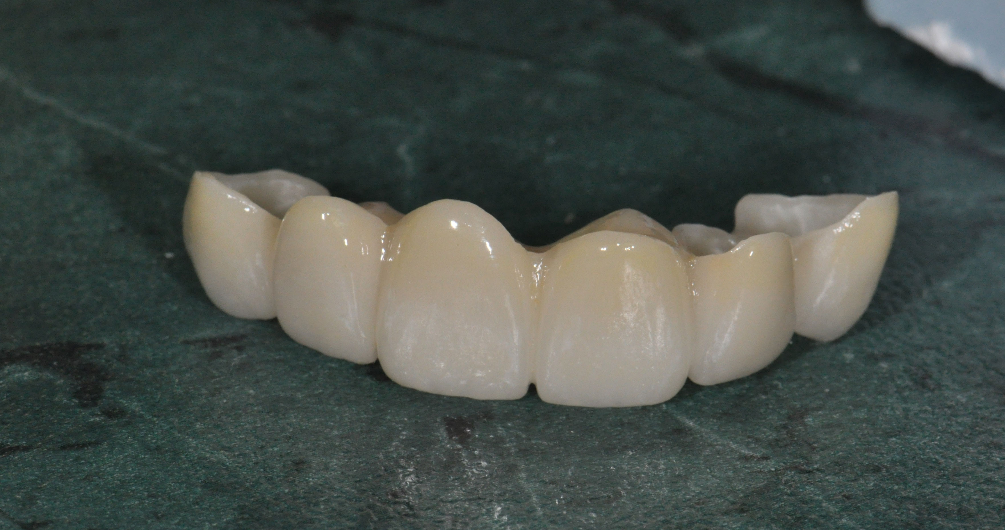 Zirconia Dental Ceramics Market Booming: What's Driving This Trend?